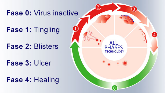 Phases of a cold sore Phases of a cold sore
